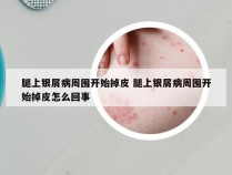 腿上银屑病周围开始掉皮 腿上银屑病周围开始掉皮怎么回事
