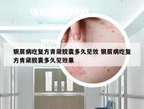 银屑病吃复方青黛胶囊多久见效 银屑病吃复方青黛胶囊多久见效果