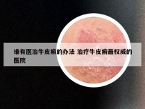 谁有医治牛皮癣的办法 治疗牛皮癣最权威的医院