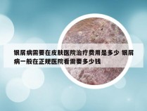 银屑病需要在皮肤医院治疗费用是多少 银屑病一般在正规医院看需要多少钱