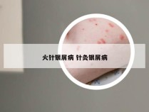 火针银屑病 针灸银屑病