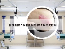 有没有脸上长牛皮癣的 脸上长牛皮肤癣