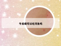 牛皮癣可以吃河鱼吗