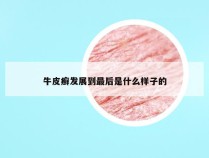 牛皮癣发展到最后是什么样子的