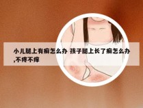 小儿腿上有癣怎么办 孩子腿上长了癣怎么办,不疼不痒