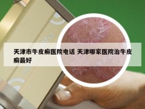 天津市牛皮癣医院电话 天津哪家医院治牛皮癣最好