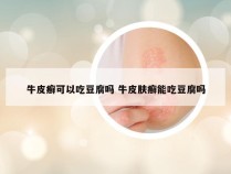 牛皮癣可以吃豆腐吗 牛皮肤癣能吃豆腐吗