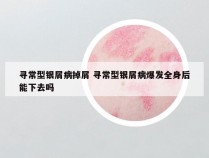 寻常型银屑病掉屑 寻常型银屑病爆发全身后能下去吗