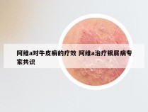 阿维a对牛皮癣的疗效 阿维a治疗银屑病专家共识