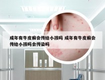 成年有牛皮癣会传给小孩吗 成年有牛皮癣会传给小孩吗会传染吗