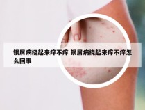 银屑病挠起来痒不痒 银屑病挠起来痒不痒怎么回事