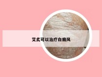 艾炙可以治疗白癜风