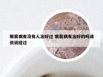 银屑病有没有人治好过 银屑病有治好的吗请说说经过