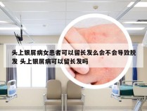 头上银屑病女患者可以留长发么会不会导致脱发 头上银屑病可以留长发吗