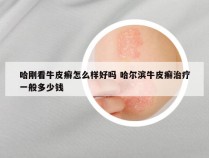 哈刚看牛皮癣怎么样好吗 哈尔滨牛皮癣治疗一般多少钱