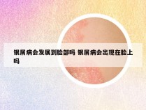 银屑病会发展到脸部吗 银屑病会出现在脸上吗