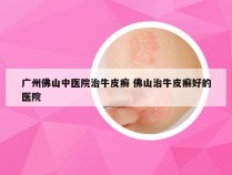 广州佛山中医院治牛皮癣 佛山治牛皮癣好的医院