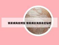 银屑病海南博鳌 银屑病去海南自愈贴吧