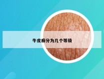 牛皮癣分为几个等级