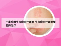 牛皮癣图牛皮癣吃什么好 牛皮癣吃什么好要坚持治疗