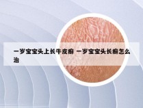 一岁宝宝头上长牛皮癣 一岁宝宝头长癣怎么治