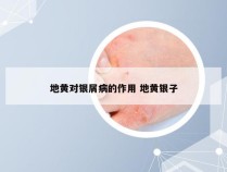 地黄对银屑病的作用 地黄银子