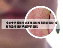 成都中医看银屑病正规医院哪家最好医院 成都市治疗银屑病最好的医院
