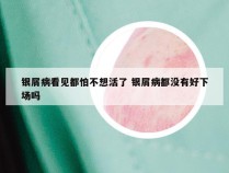 银屑病看见都怕不想活了 银屑病都没有好下场吗