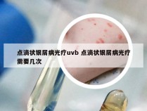 点滴状银屑病光疗uvb 点滴状银屑病光疗需要几次