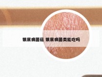 银屑病菌菇 银屑病菌类能吃吗