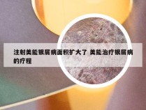 注射美能银屑病面积扩大了 美能治疗银屑病的疗程