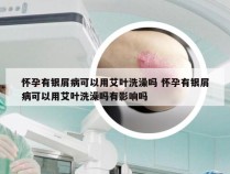 怀孕有银屑病可以用艾叶洗澡吗 怀孕有银屑病可以用艾叶洗澡吗有影响吗