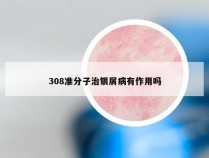 308准分子治银屑病有作用吗