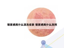 银屑病用什么清洗皮肤 银屑病用什么洗剂