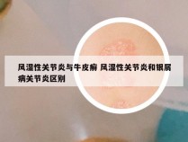 风湿性关节炎与牛皮癣 风湿性关节炎和银屑病关节炎区别