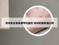 郑州有名银屑病专科医院 郑州的银屑病口碑