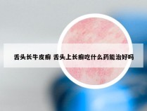 舌头长牛皮癣 舌头上长癣吃什么药能治好吗