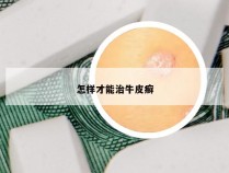 怎样才能治牛皮癣