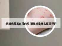 银翘病是怎么得的呢 银翘病是什么原因得的