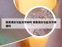 银屑病会引起关节肿吗 银屑病会引起关节疼痛吗