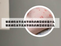 银屑病性关节炎关节损伤的典型症状是什么 银屑病性关节炎关节损伤的典型症状是什么