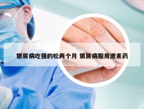 银屑病吃强的松两个月 银屑病服用激素药