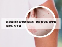 银屑病可以买重疾保险吗 银屑病可以买重疾保险吗多少钱