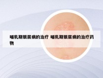 哺乳期银屑病的治疗 哺乳期银屑病的治疗药物