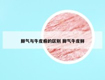 脚气与牛皮癣的区别 脚气牛皮鲜