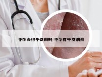 怀孕会得牛皮癣吗 怀孕有牛皮病癣