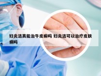 妇炎洁真能治牛皮癣吗 妇炎洁可以治疗皮肤病吗