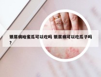 银屑病哈蜜瓜可以吃吗 银屑病可以吃瓜子吗?