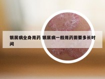 银屑病全身用药 银屑病一般用药需要多长时间