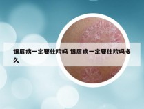 银屑病一定要住院吗 银屑病一定要住院吗多久
